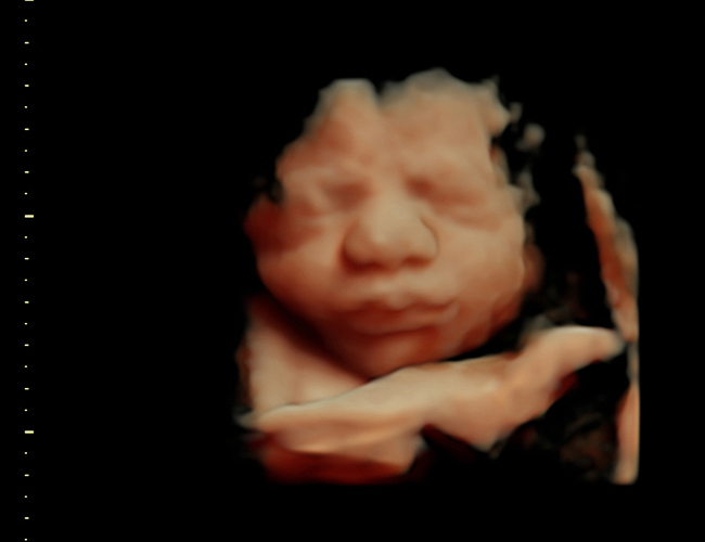 3D ultrasound image at 31 weeks